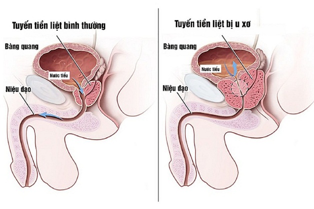 U xơ tuyến tiền liệt bệnh học – Bệnh của đa số đàn ông