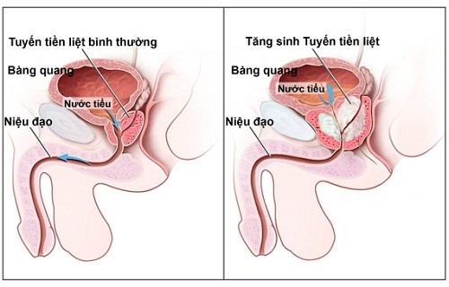 U xơ tuyến tiền liệt làm sao để loại bỏ hiệu quả