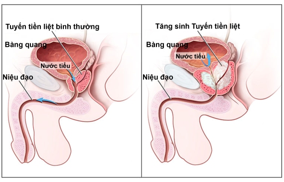 u xo tuyen tien liet o nam gioi 2