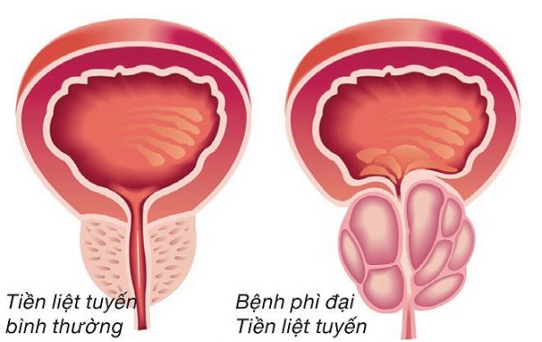 U xơ tuyến tiền liệt và những biến chứng nguy hiểm