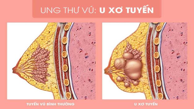 U xơ tuyến vú lành tính là gì và có đáng lo ngại không