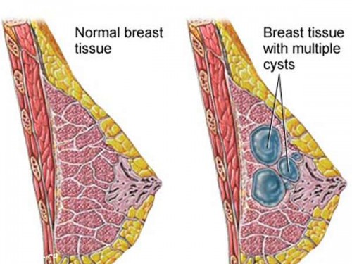 U xơ và u nang tuyến vú khác nhau thế nào?