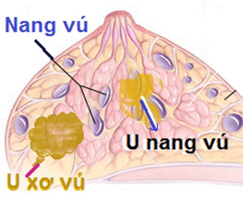 U xơ và u nang tuyến vú khác nhau thế nào?