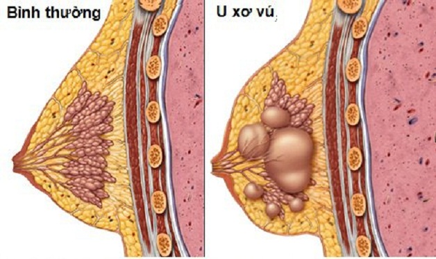 U xơ vú có nên mổ không và mổ bằng phương pháp nào?