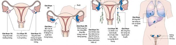 Ung thư buồng trứng di căn sống được bao lâu?