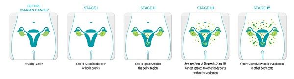 Ung thư buồng trứng giai đoạn cuối có chữa khỏi không?