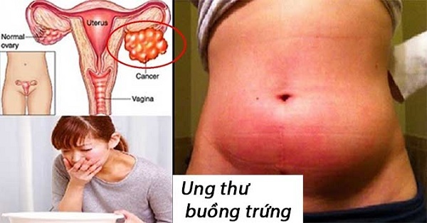 Ung thư buồng trứng giai đoạn cuối