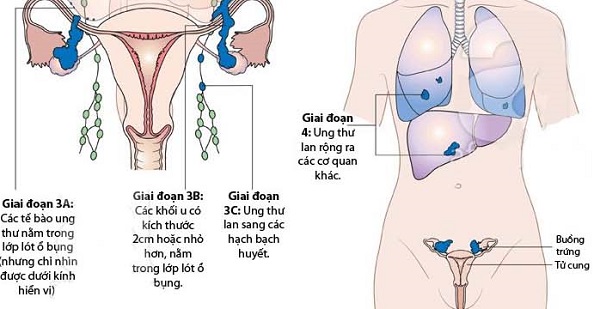 Ung thư buồng trứng giai đoạn cuối