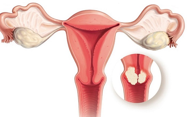 Ung thư cổ tử cung có chữa khỏi không?