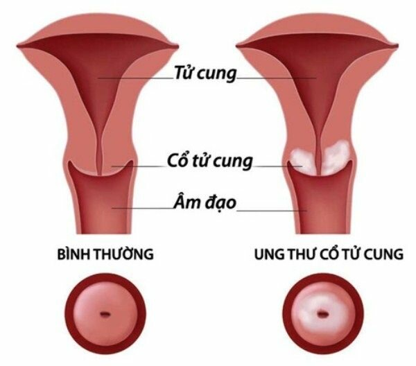 “Ung thư cổ tử cung có xu hướng trẻ hơn do quan hệ