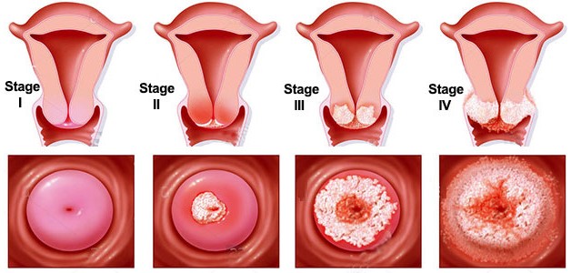 Ung thư cổ tử cung giai đoạn 2 và cách điều trị