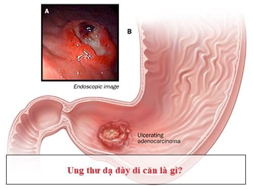 Ung thư dạ dày di căn là gì?