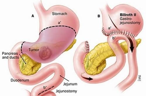 Ung thư dạ dày giai đoạn đầu sống được bao lâu?