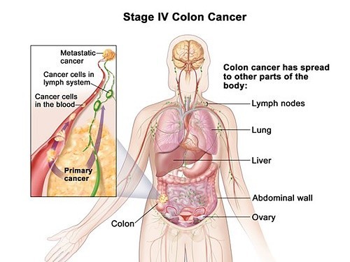 Ung thư đại tràng di căn sống được bao lâu?