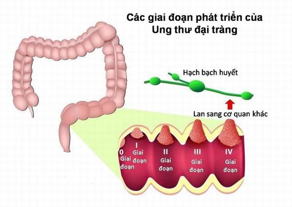 Ung thư đại tràng di căn