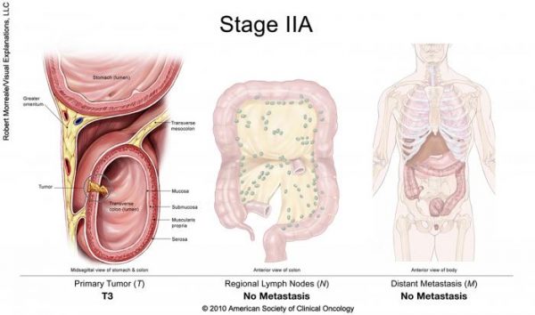 Ung thư đại tràng giai đoạn 2 sống được bao lâu?