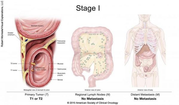 Ung thư đại tràng giai đoạn đầu có chữa khỏi không?