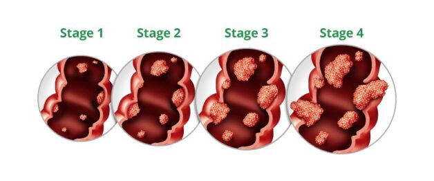 Ung thư đại tràng giai đoạn III: Biểu hiện và điều trị