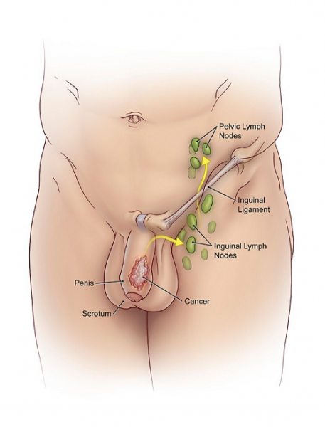 Ung thư dương vật – nguyên nhân, triệu chứng và cách điều trị