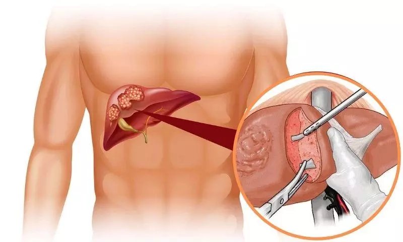 Ung thư gan điều trị thành công nhờ phác đồ đúng hướng