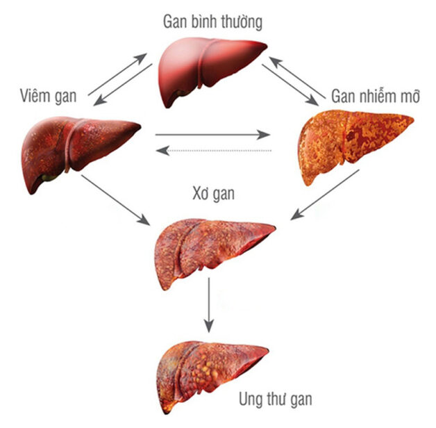 Ung thư gan giai đoạn 2 và các thông tin quan trọng