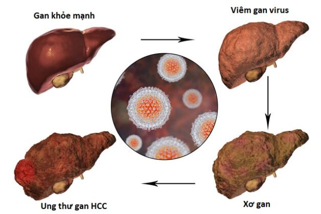 Ung thư gan hcc là gì và cách phòng tránh