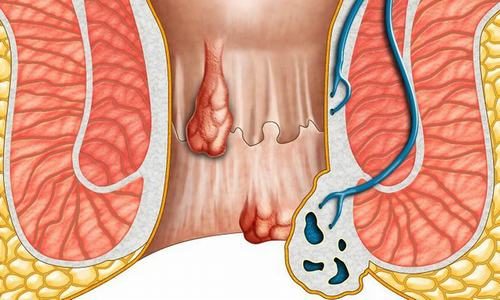 Ung thư hậu môn có chữa được không?