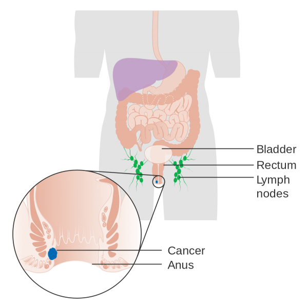 Ung thư hậu môn giai đoạn IV