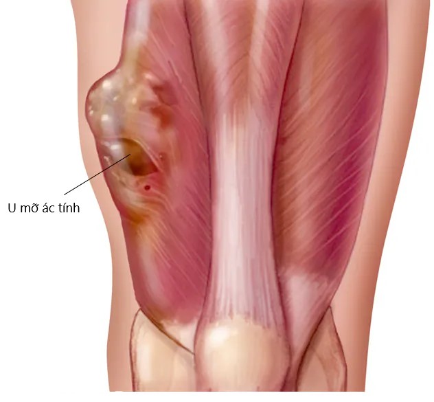 Ung thư mỡ: Những thông tin quan trọng