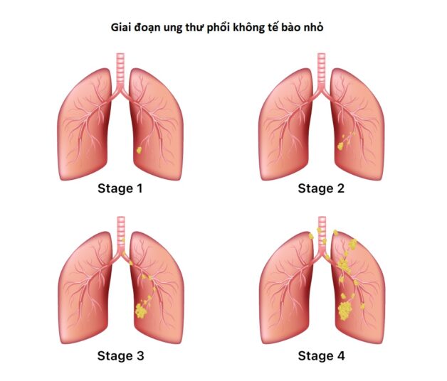 Ung thư phổi có mấy giai đoạn và tiên lượng sống