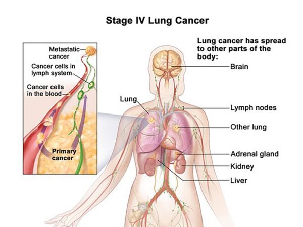Ung thư phổi di căn lên não