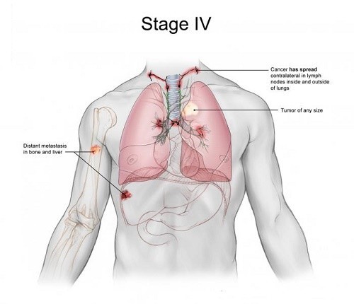 Ung thư phổi giai đoạn 4 có chữa được không?