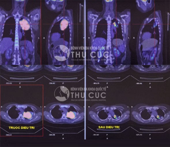 Ung thư phổi: Nguy hiểm nhưng có thể điều trị