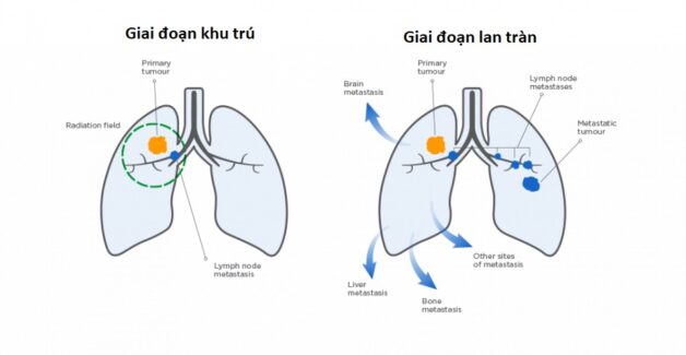 Ung thư phổi tế bào nhỏ: ít phổ biến nhưng rất nguy hiểm