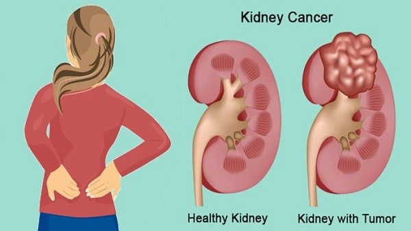 Ung thư thận chữa thế nào? các tế bào trong thận