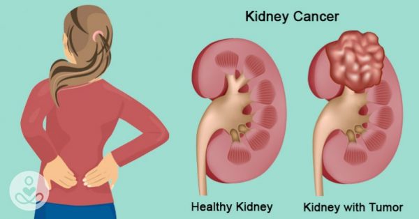 Ung thư thận có chữa được không?