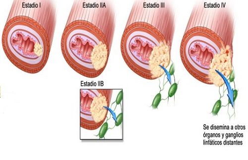 Ung thư thực quản giai đoạn cuối và những điều cần biết