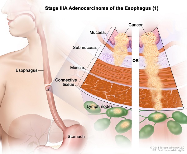 Ung thư thực quản giai đoạn III