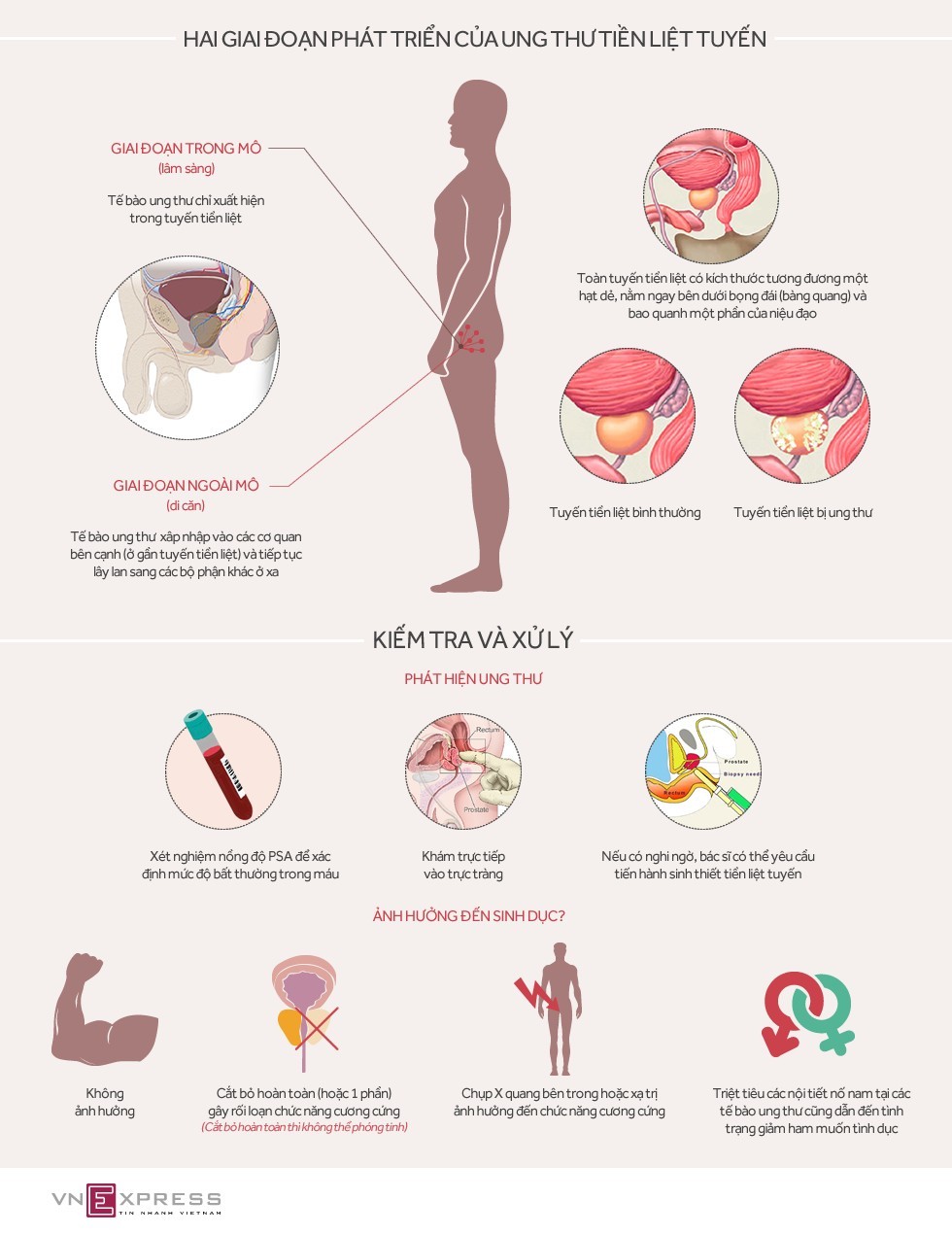 Ung thư tiền liệt tuyến ảnh hưởng ra sao đến sinh dục nam?