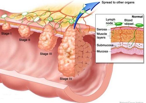 Ung thư trực tràng có mấy giai đoạn?