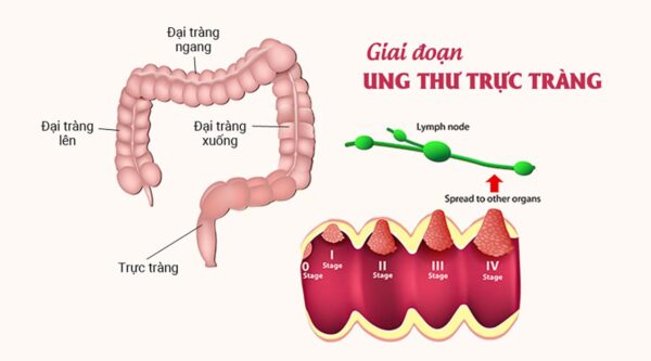 Ung thư trực tràng di căn và những điều cần biết