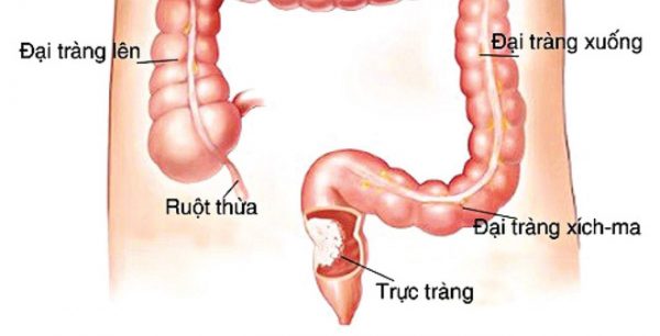 Ung thư trực tràng giai đoạn đầu