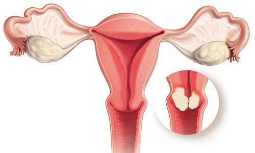 Ung thư tử cung có lây không? là mối lo ngại hàng đầu