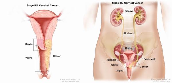 Ung thư tử cung – những điều cần biết