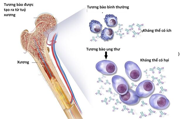 Ung thư tủy có chữa được không và cách điều trị?