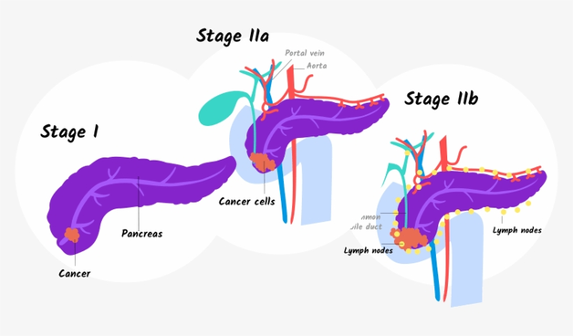 Ung thư tụy giai đoạn 2 và dấu hiệu bạn cần biết