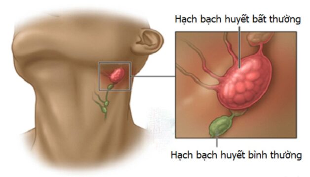 Ung thư tuyến giáp di căn hạch cổ là gì, cách điều trị