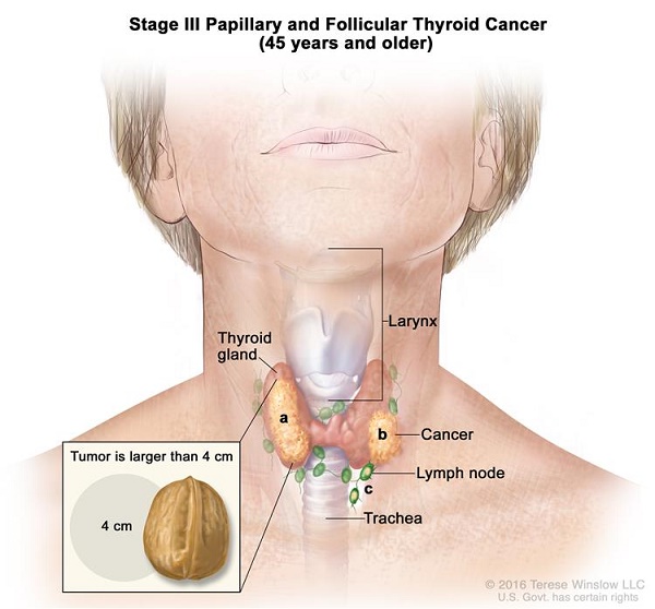 Ung thư tuyến giáp giai đoạn III chữa thế nào?