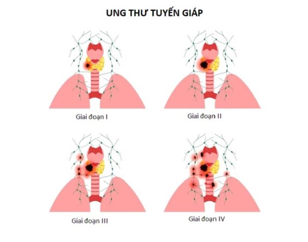 Ung thư tuyến giáp thể nhú có nguy hiểm không?