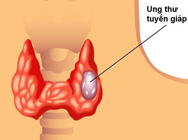 Ung thư tuyến giáp – Tỉ lệ chữa khỏi lên tới 100%